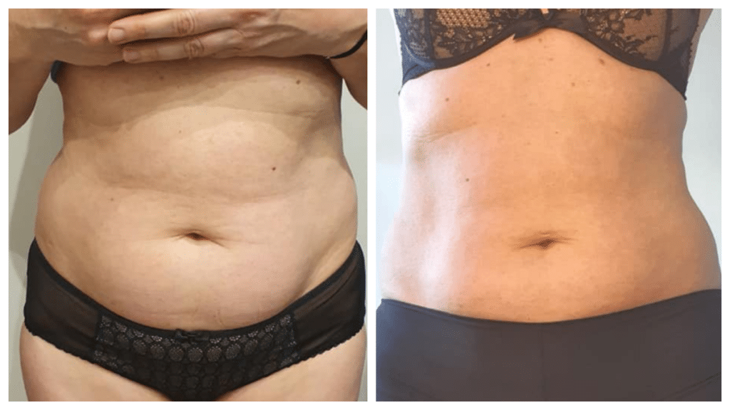 Transformation avant et après de Delphine